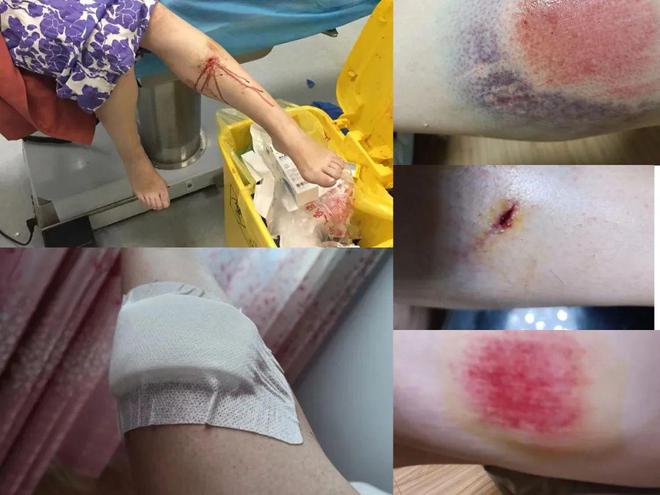 吓人！事发滨州一小区：走着走着掉进检查井！网友拼命爬出多处受伤(图1)